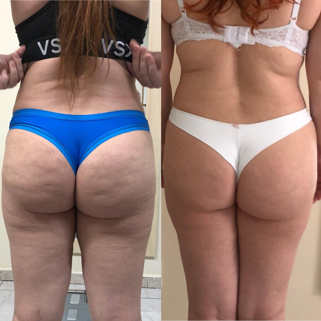 Antes e depois — região do glúteo