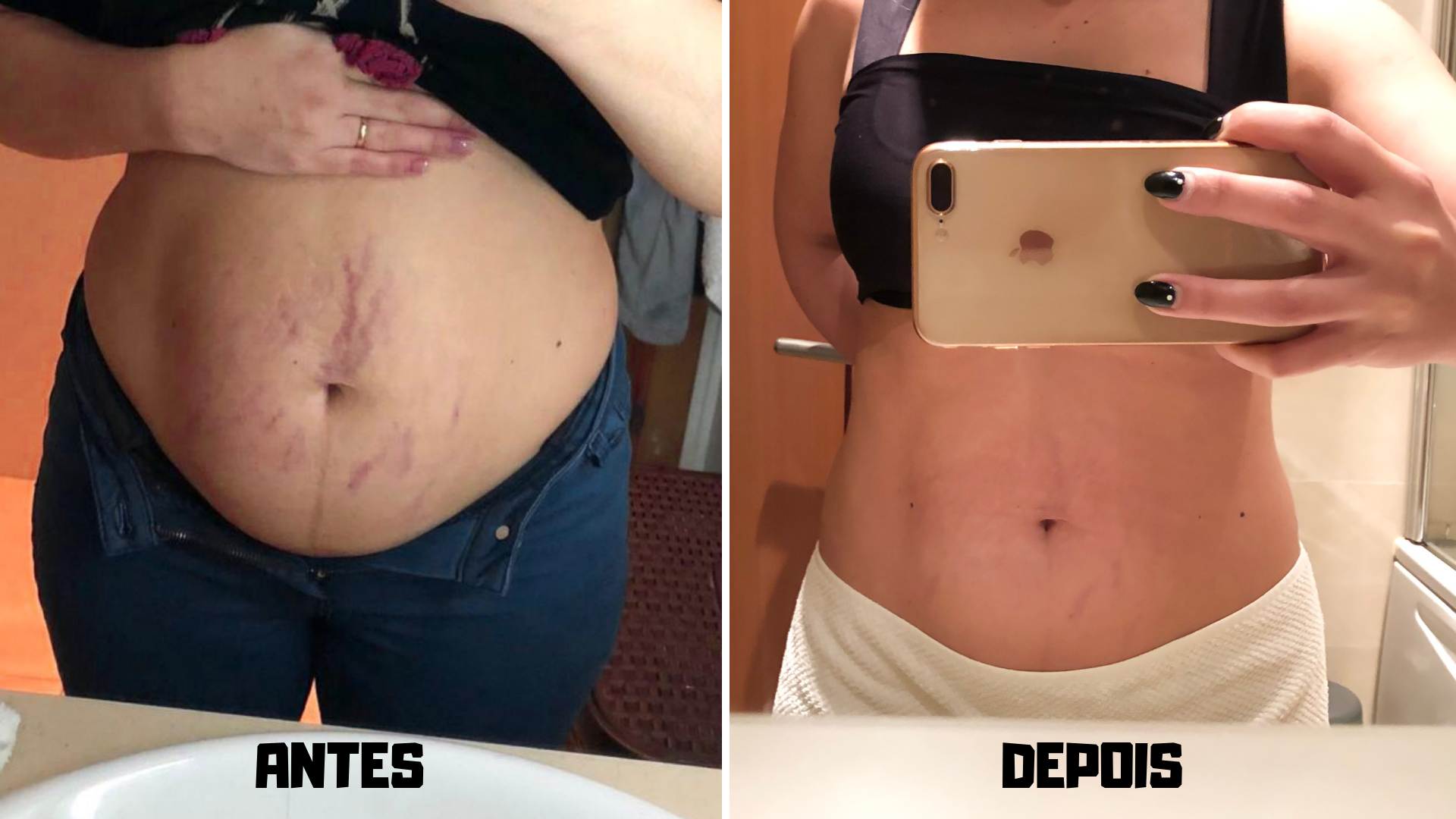 Antes e depois — barriga
