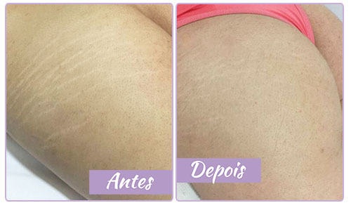 Antes e depois — coxa
