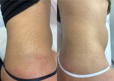 Antes e depois — Estrias brancas e vermelhas, antigas e novas