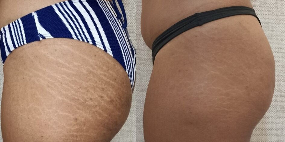 Antes e depois — Textura da pele em pernas e glúteos