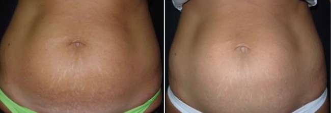 Antes e depois — Estrias em região abdominal