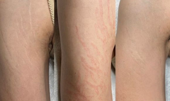 Antes e depois — Marcas em braços e lateral do corpo