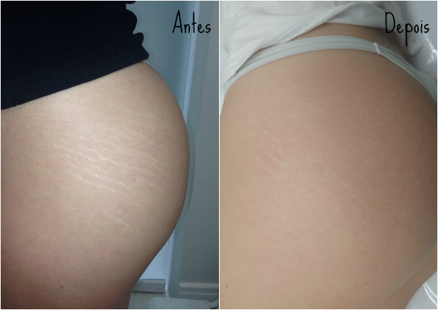 Antes e depois — perna
